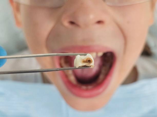 Best Emergency Wisdom Teeth Removal in Pomona, NJ